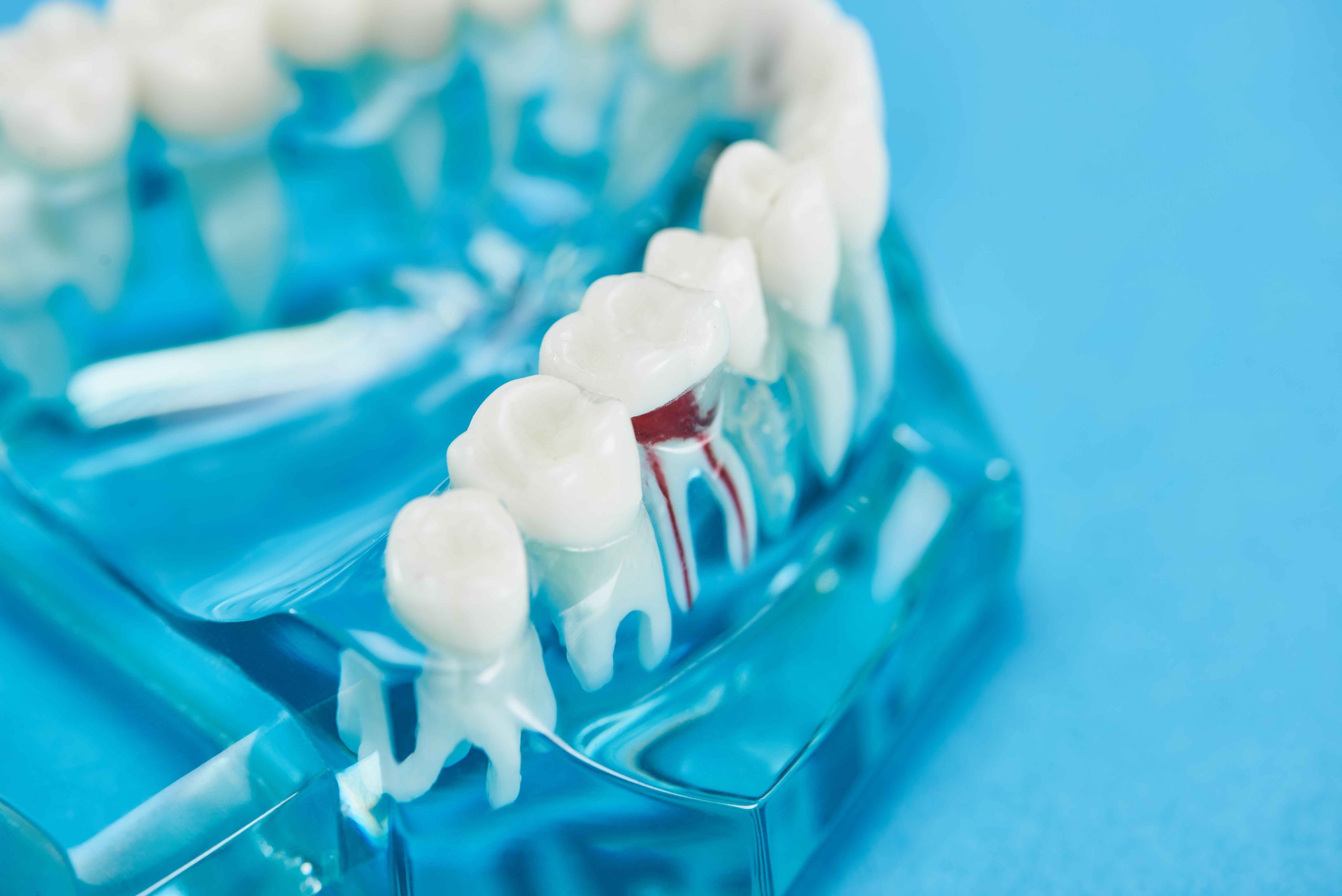 Root Canal Cost Dubai Explained: What You Should Know Before Treatment